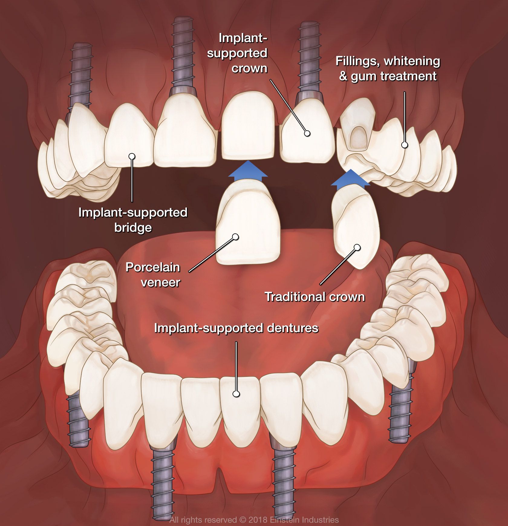 Full Mouth Reconstruction Illustration